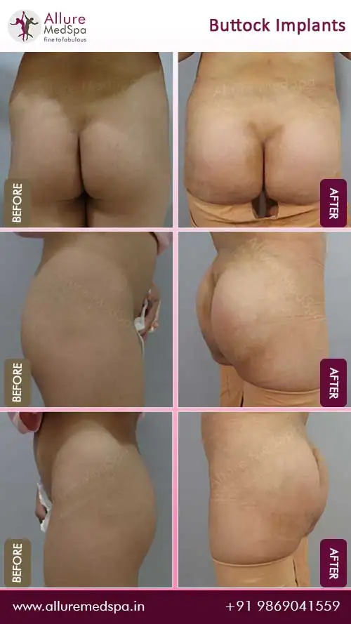 Buttock Enhancement Before and After Photos - SF Plastic Surgeon