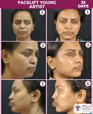 Face Lift Surgery: Facial Plastic Surgery Cost in Mumbai, India