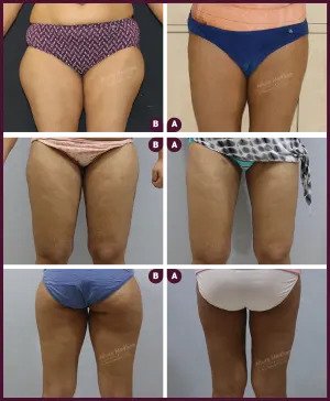 By opting for liposuction under local anesthesia, you can achieve your  ideal body shape in just 2-3 hours. The procedure involves the u