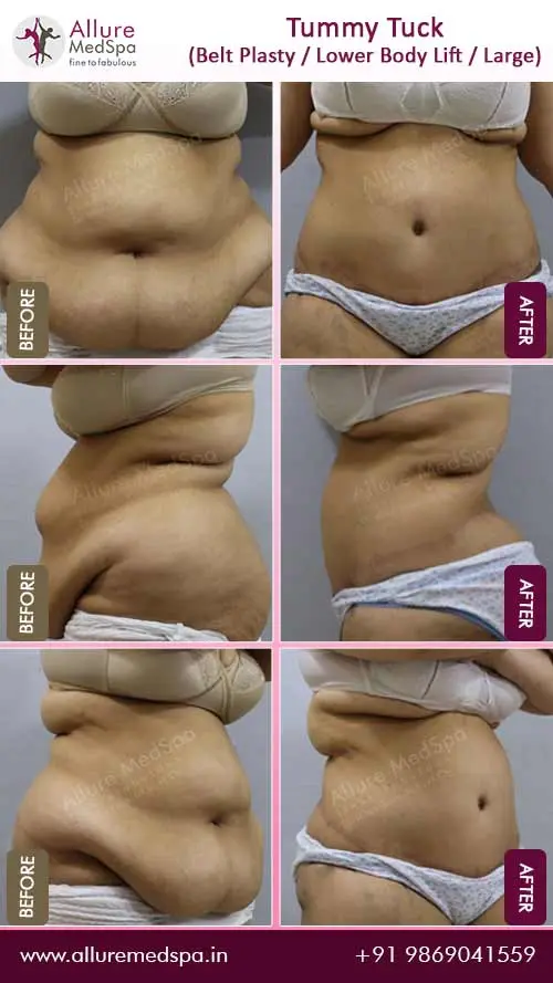 A surgical procedure to correct saggy and shapeless breasts after