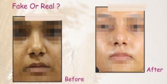 Rhinoplasty before after image are they real or fake?