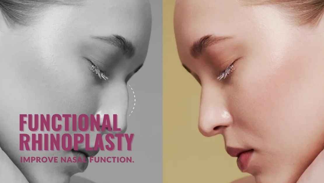 Functional rhinoplasty