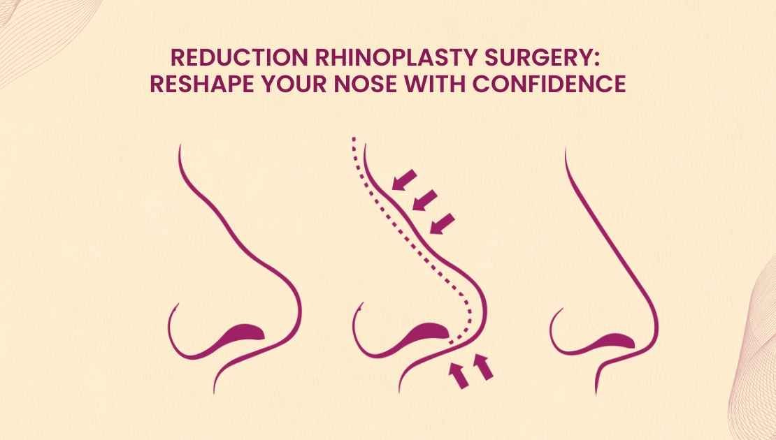 Reduction Rhinoplasty